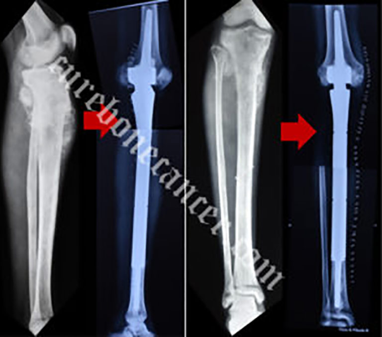 Limb Salvage Surgery Treatment in India