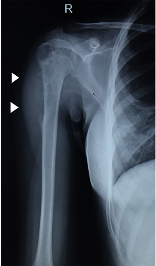 What Causes Sarcoma In Arm